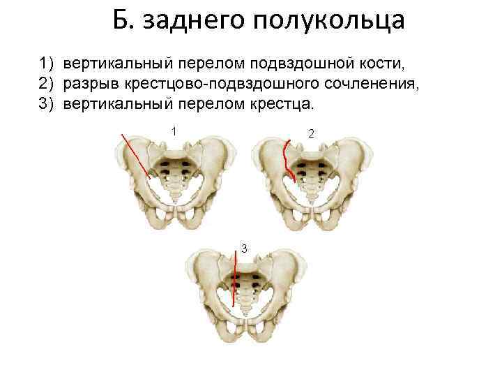 Б. заднего полукольца 1) вертикальный перелом подвздошной кости, 2) разрыв крестцово-подвздошного сочленения, 3) вертикальный