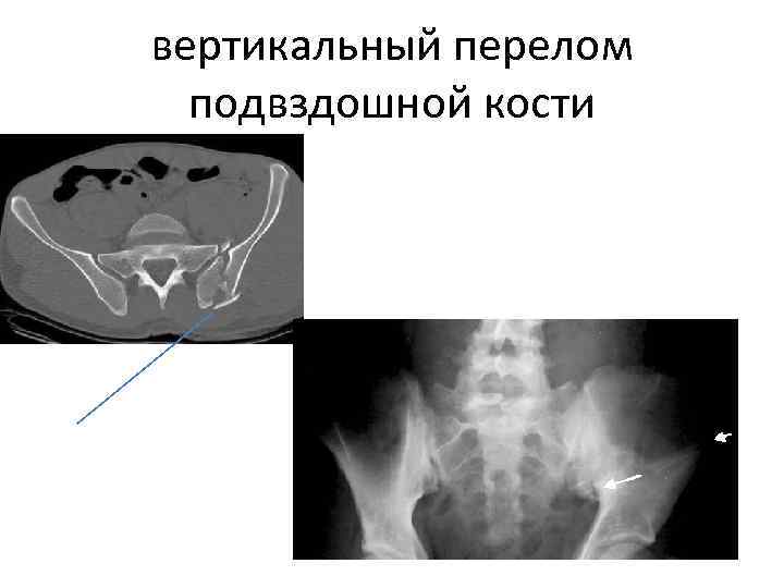 вертикальный перелом подвздошной кости 