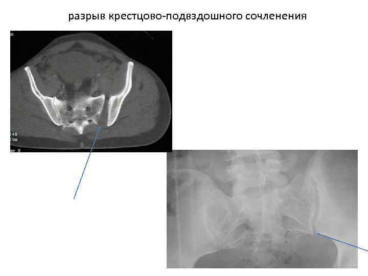 разрыв крестцово-подвздошного сочленения 