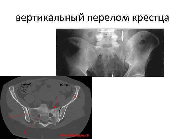 вертикальный перелом крестца 