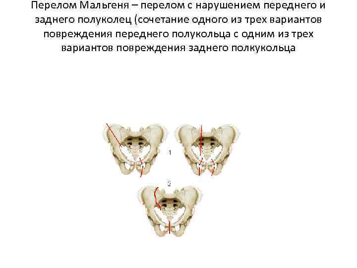 Перелом Мальгеня – перелом с нарушением переднего и заднего полуколец (сочетание одного из трех