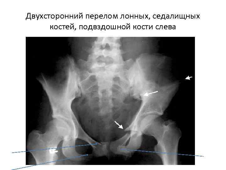 Двухсторонний перелом лонных, седалищных костей, подвздошной кости слева 