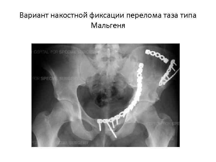 Вариант накостной фиксации перелома таза типа Мальгеня 