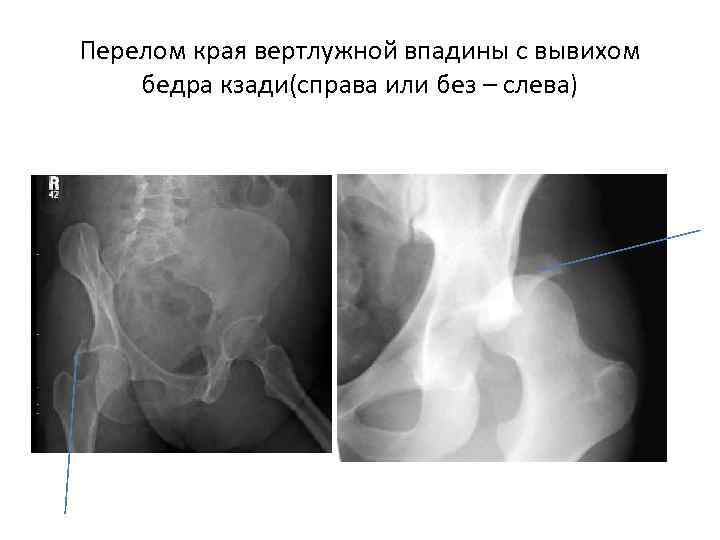 Перелом края вертлужной впадины с вывихом бедра кзади(справа или без – слева) 