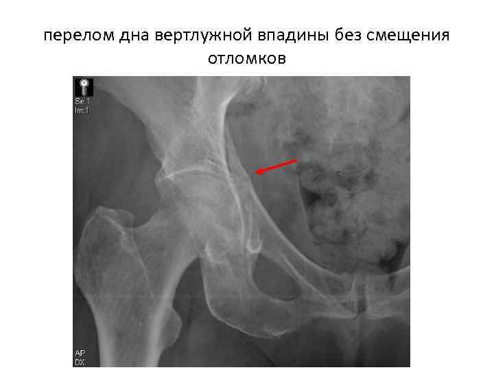 перелом дна вертлужной впадины без смещения отломков 