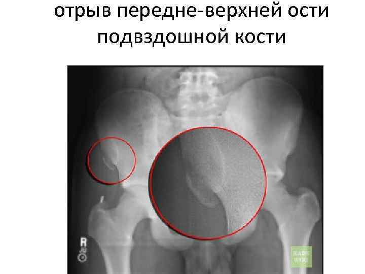 отрыв передне-верхней ости подвздошной кости 