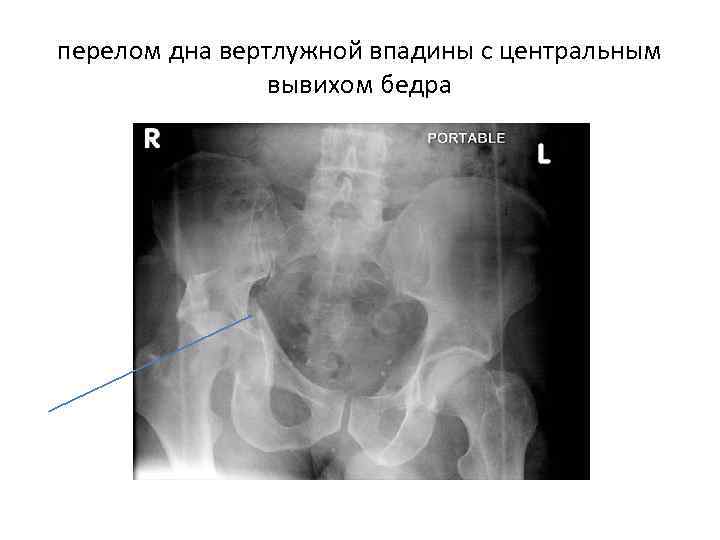 перелом дна вертлужной впадины с центральным вывихом бедра 