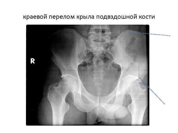 краевой перелом крыла подвздошной кости 