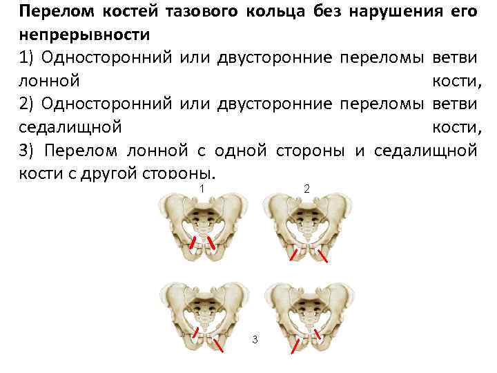 Перелом костей тазового кольца без нарушения его непрерывности 1) Односторонний или двусторонние переломы ветви