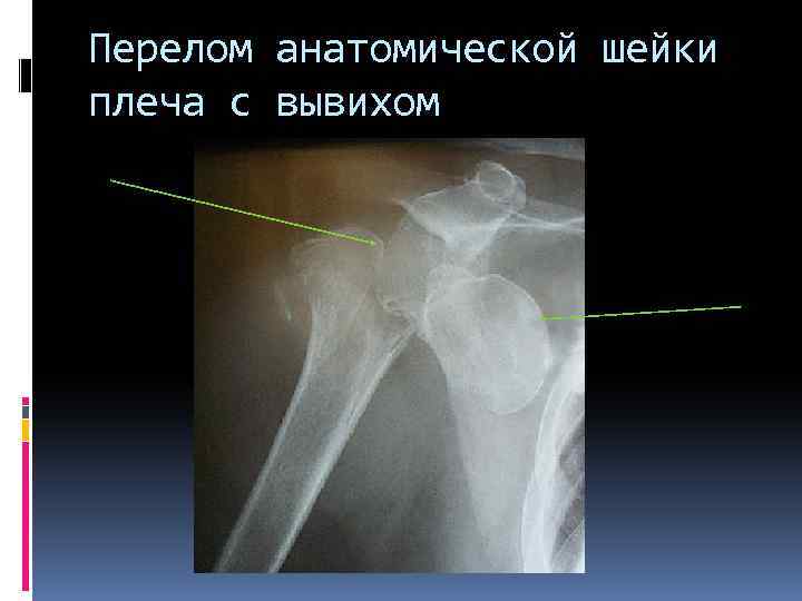 Перелом анатомической шейки плеча с вывихом 