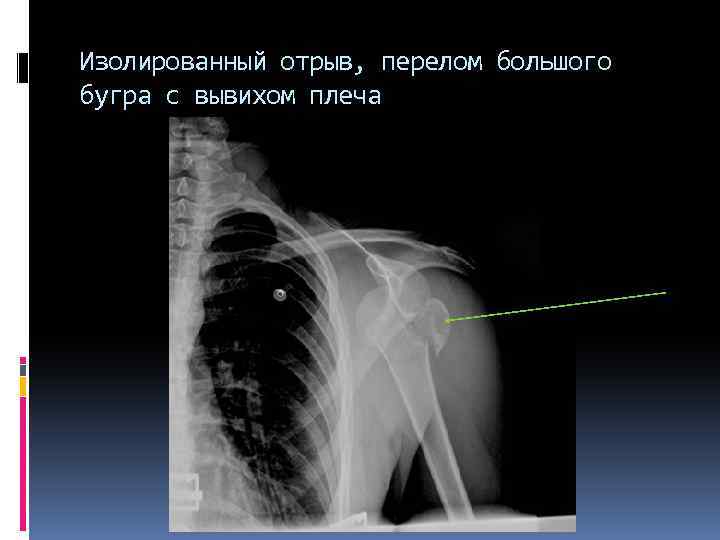 Изолированный отрыв, перелом большого бугра с вывихом плеча 