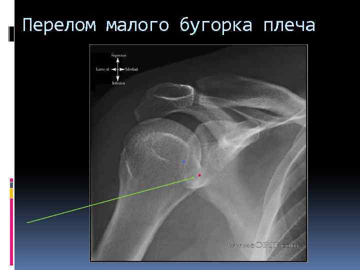 Перелом малого бугорка плеча 