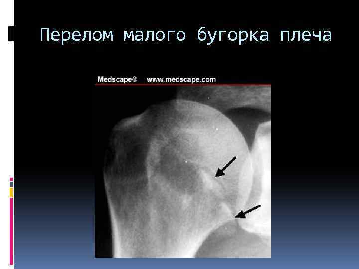 Перелом малого бугорка плеча 