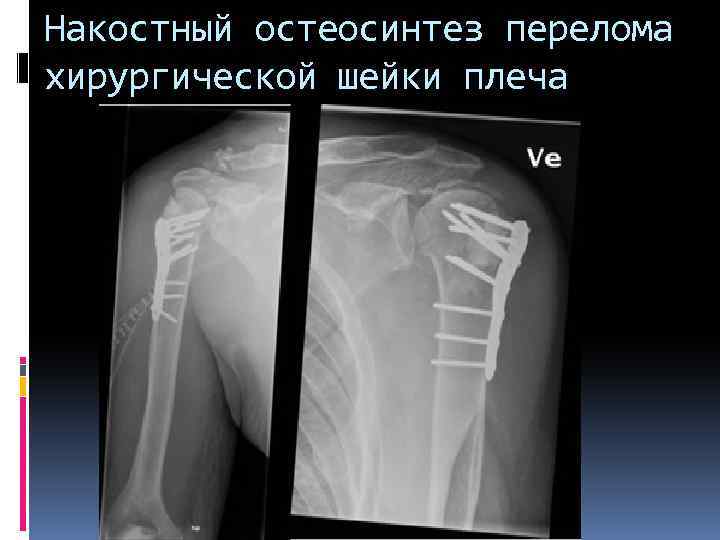 Накостный остеосинтез перелома хирургической шейки плеча 