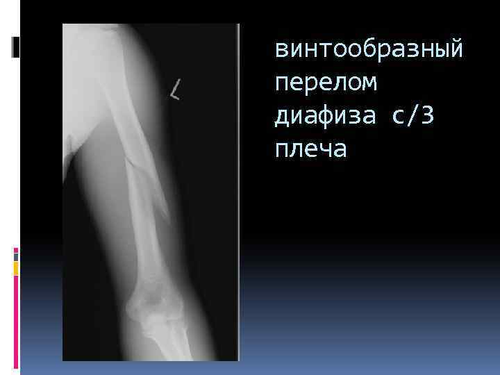 винтообразный перелом диафиза с/3 плеча 