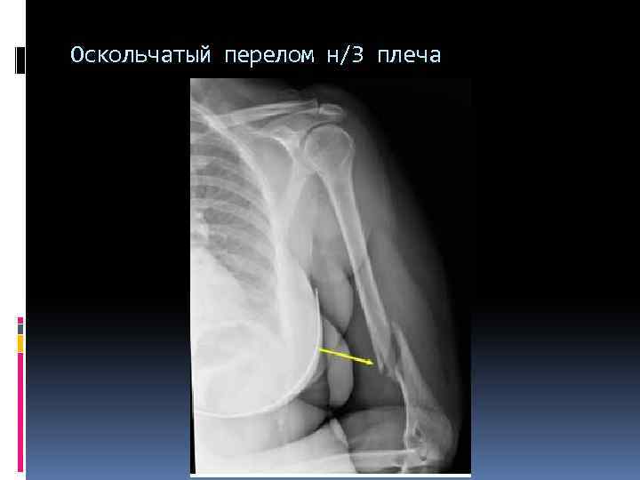 Оскольчатый перелом н/3 плеча 