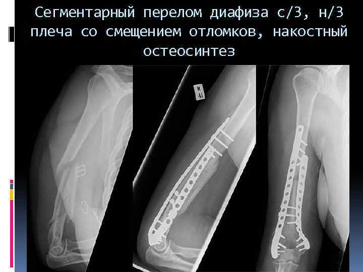 Сегментарный перелом диафиза с/3, н/3 плеча со смещением отломков, накостный остеосинтез 