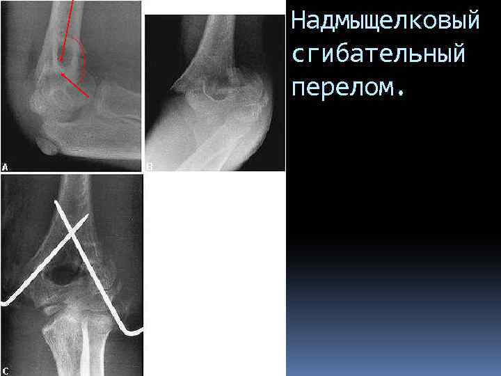 Надмыщелковый сгибательный перелом. 