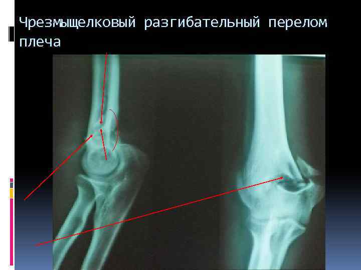 Чрезмыщелковый разгибательный перелом плеча 