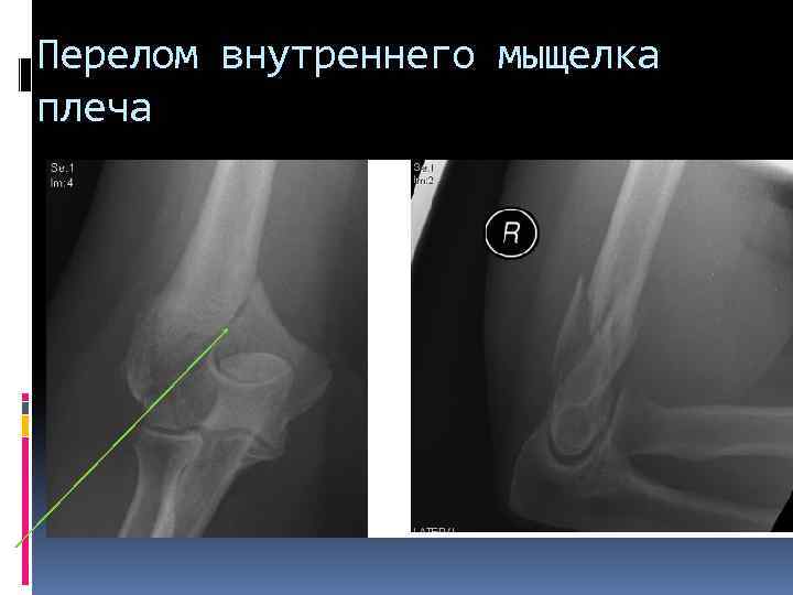 Перелом внутреннего мыщелка плеча 