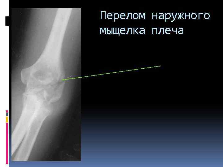 Перелом наружного мыщелка плеча 