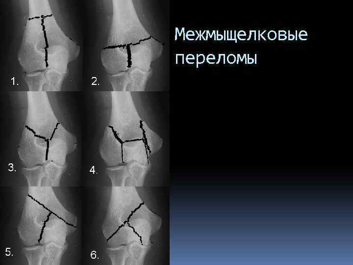 Межмыщелковые переломы 