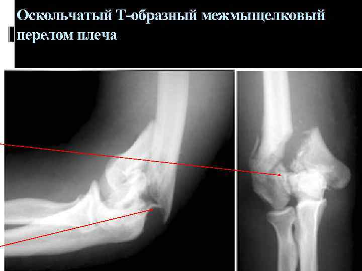 Оскольчатый Т-образный межмыщелковый перелом плеча 