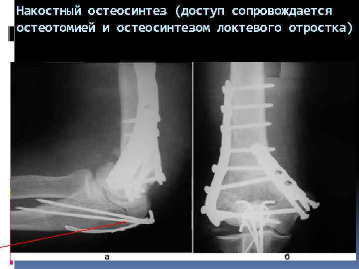 Накостный остеосинтез (доступ сопровождается остеотомией и остеосинтезом локтевого отростка) 