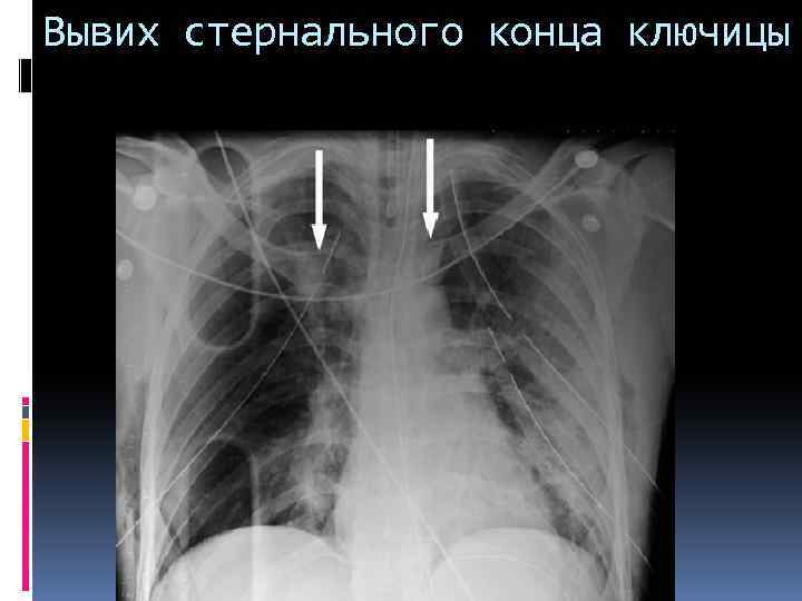 Вывих стернального конца ключицы 