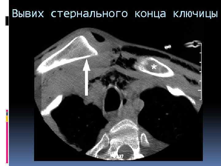 Вывих стернального конца ключицы 