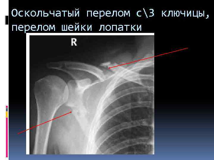 Оскольчатый перелом с3 ключицы, перелом шейки лопатки 