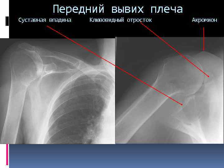 Передний вывих плеча Суставная впадина Клювовидный отросток Акромион 