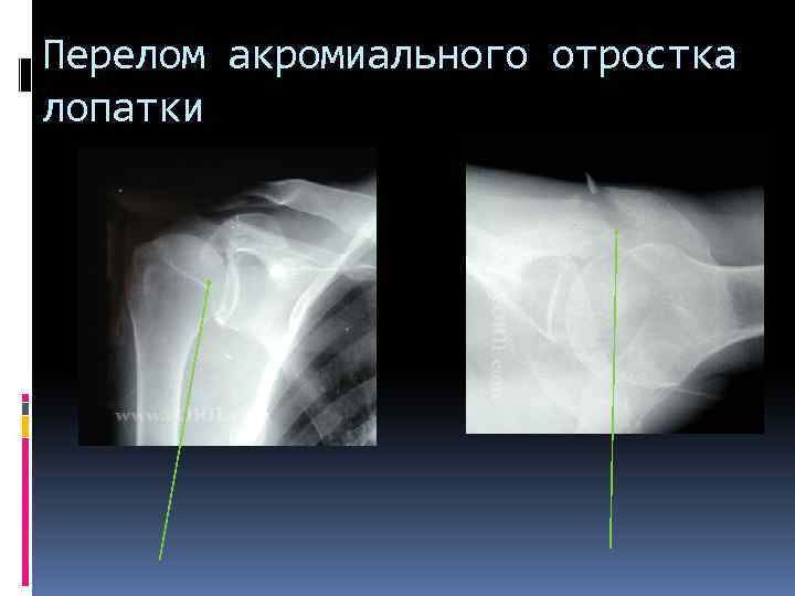 Перелом акромиального отростка лопатки 