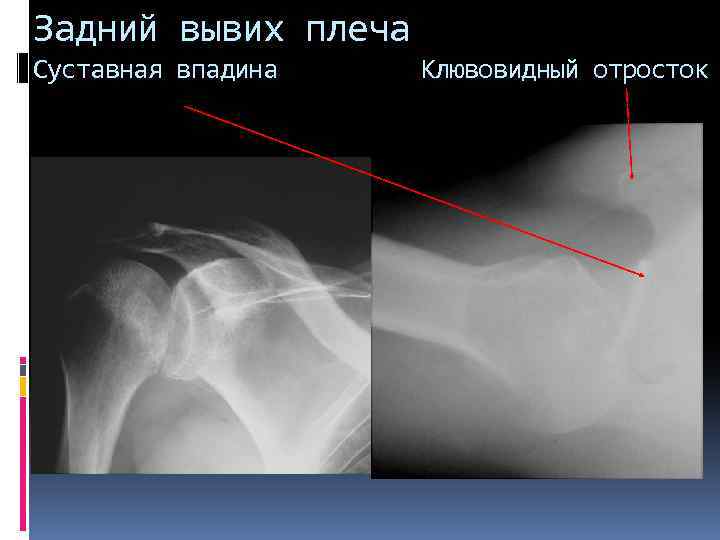 Задний вывих плеча Суставная впадина Клювовидный отросток 