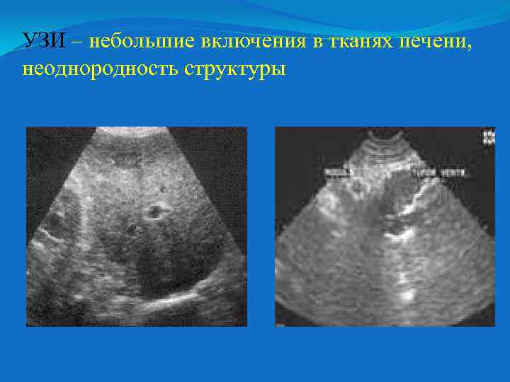 УЗИ – небольшие включения в тканях печени, неоднородность структуры 