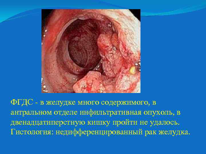 ФГДС - в желудке много содержимого, в антральном отделе инфильтративная опухоль, в двенадцатиперстную кишку