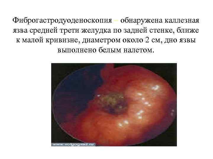 Фиброгастродуоденоскопия – обнаружена каллезная язва средней трети желудка по задней стенке, ближе к малой