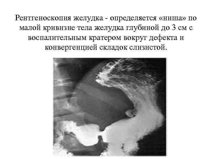 Рентгеноскопия желудка - определяется «ниша» по малой кривизне тела желудка глубиной до 3 см