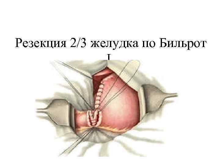 Резекция 2/3 желудка по Бильрот I. 