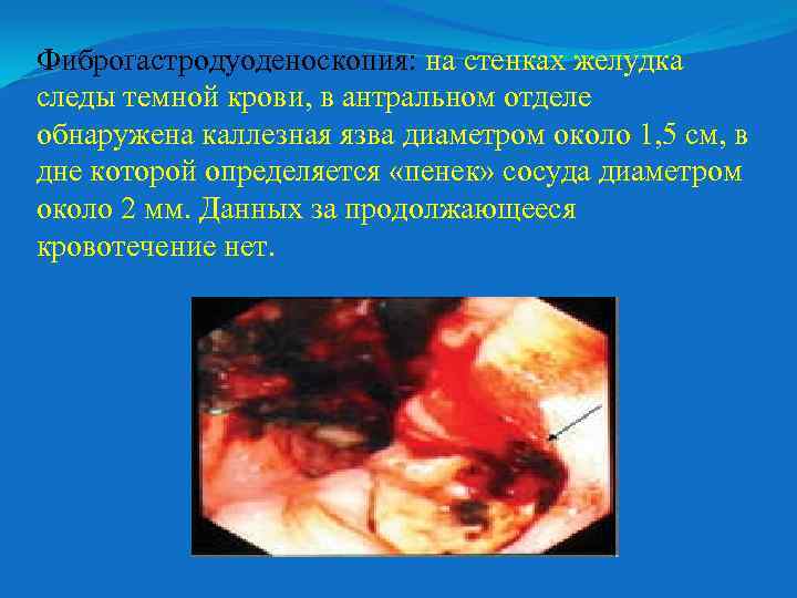 Фиброгастродуоденоскопия: на стенках желудка следы темной крови, в антральном отделе обнаружена каллезная язва диаметром
