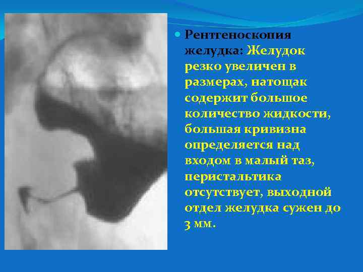  Рентгеноскопия желудка: Желудок резко увеличен в размерах, натощак содержит большое количество жидкости, большая