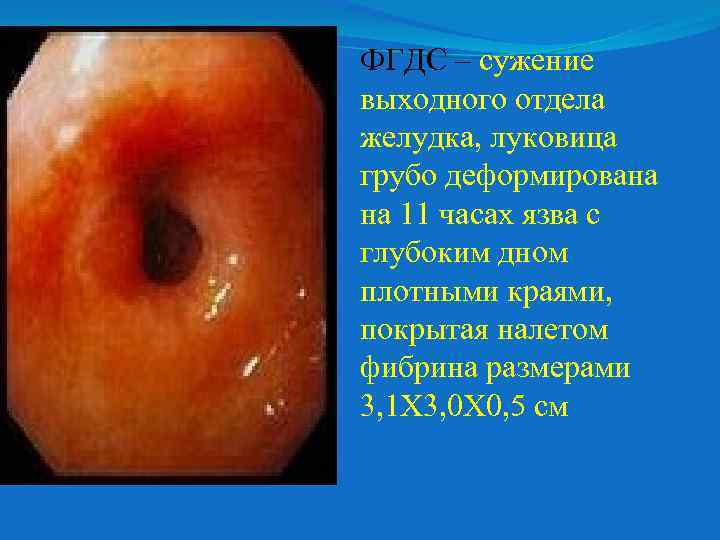ФГДС – сужение выходного отдела желудка, луковица грубо деформирована на 11 часах язва с