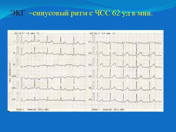 ЭКГ –синусовый ритм с ЧСС 62 уд в мин. 