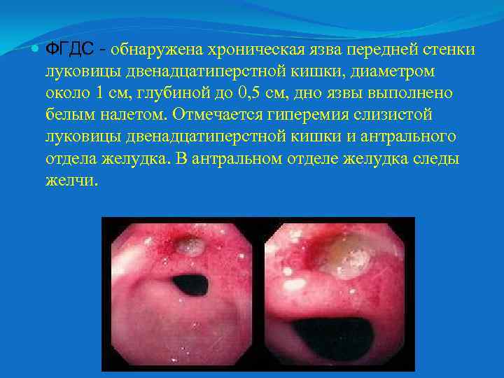  ФГДС - обнаружена хроническая язва передней стенки луковицы двенадцатиперстной кишки, диаметром около 1