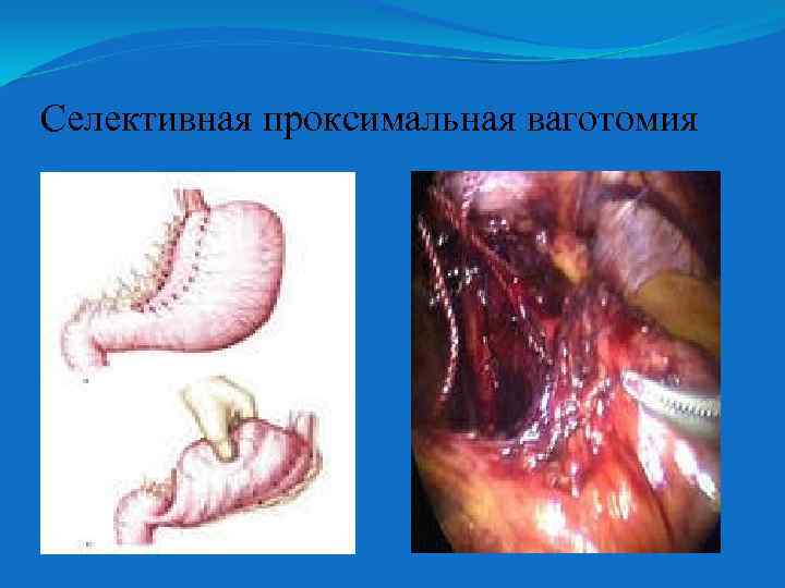 Селективная проксимальная ваготомия 