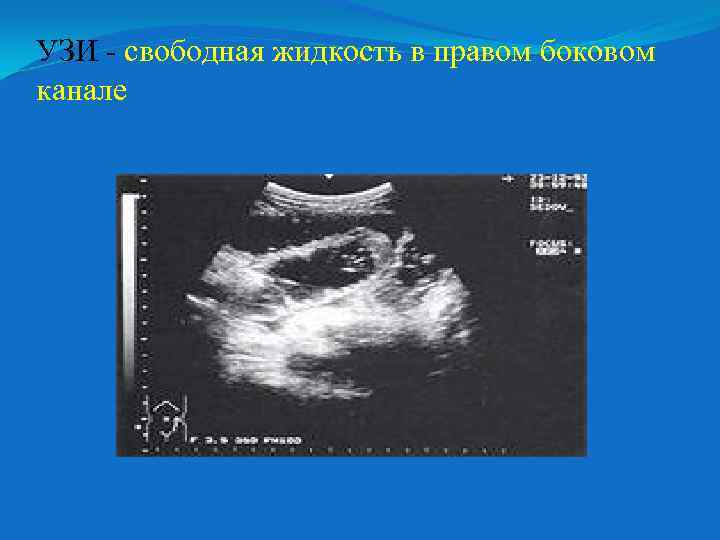УЗИ - свободная жидкость в правом боковом канале 