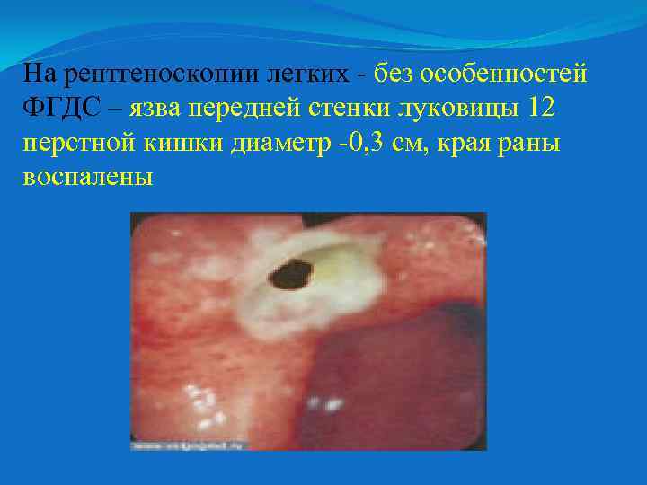 На рентгеноскопии легких - без особенностей ФГДС – язва передней стенки луковицы 12 перстной