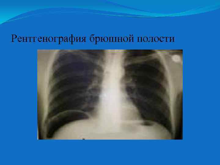 Рентгенография брюшной полости 