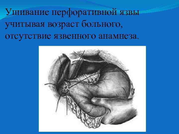 Ушивание перфоративной язвы учитывая возраст больного, отсутствие язвенного анамнеза. 