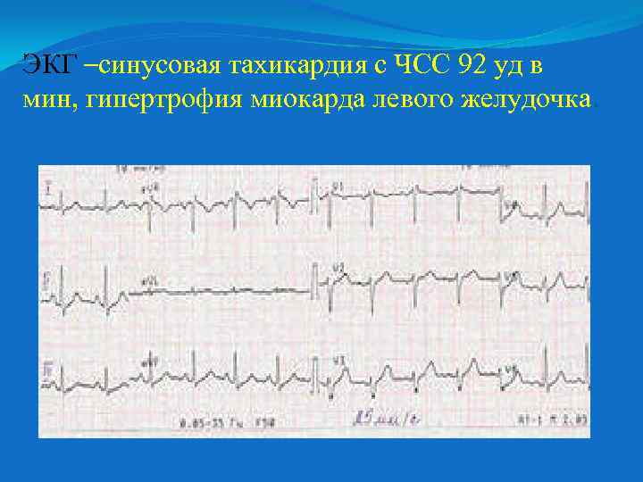 ЭКГ –синусовая тахикардия с ЧСС 92 уд в мин, гипертрофия миокарда левого желудочка. 